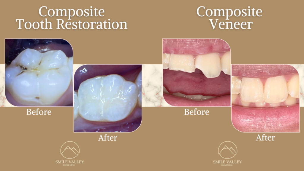 Restorative Dental Treatment – The Valley Dental Hub